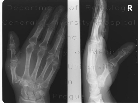 Bennett's fracture of the right hand