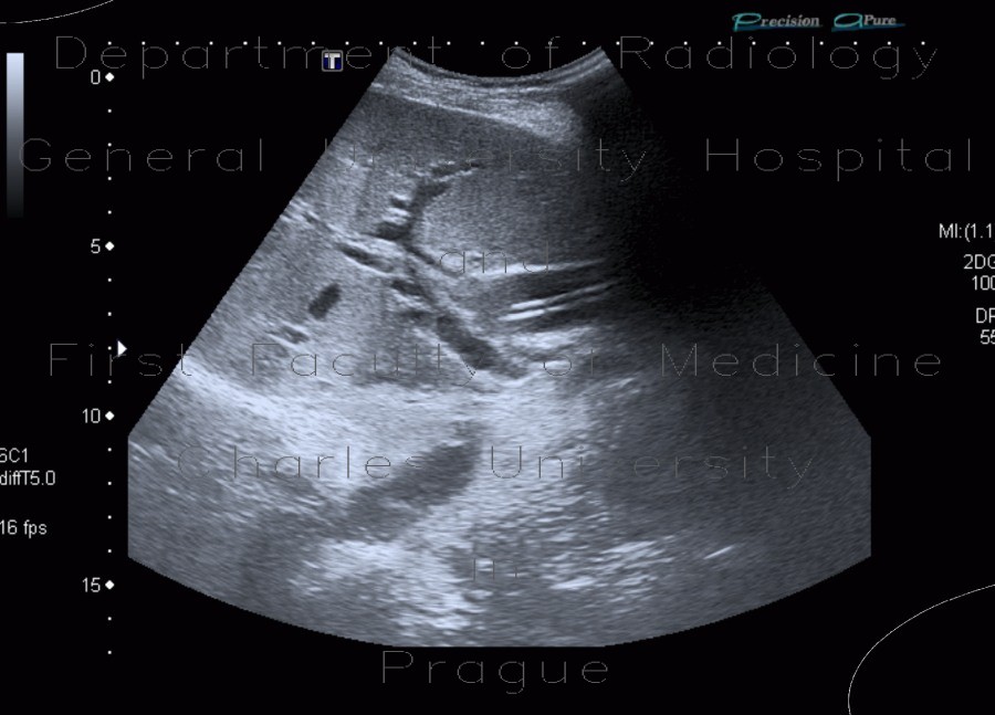 Radiology image - Biliary stent, obstruction: Abdomen, Biliary tree: US - Ultrasound