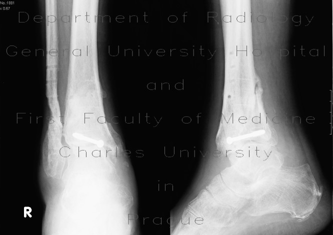 Bimalleolar fracture with fracture of the posterior edge of tibia, after removal of compreson plate