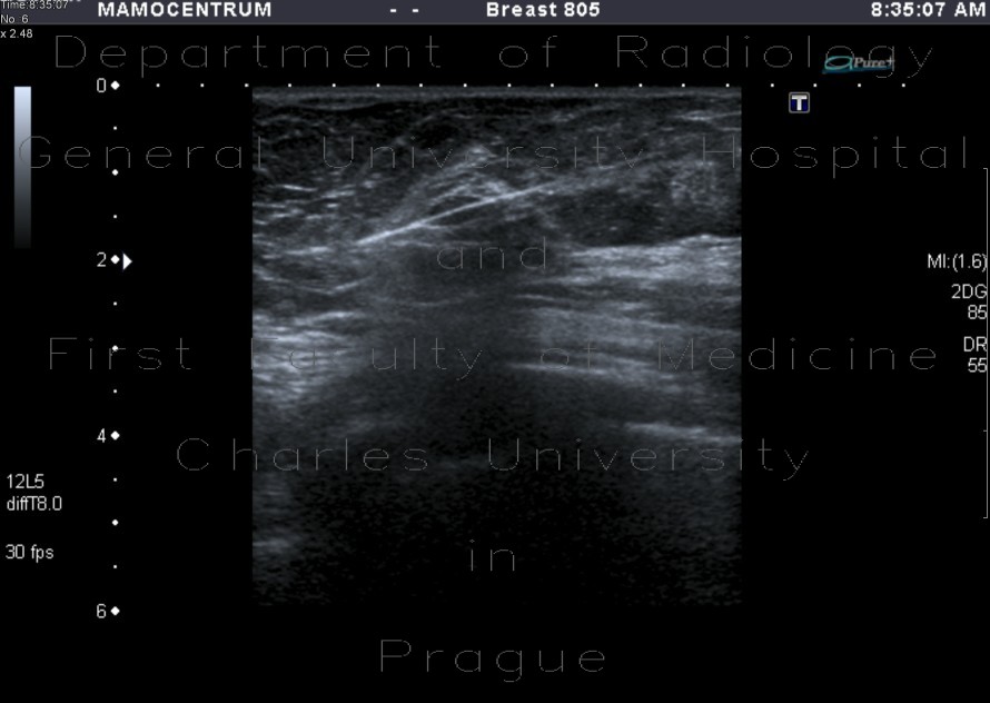 Biopsy of breast