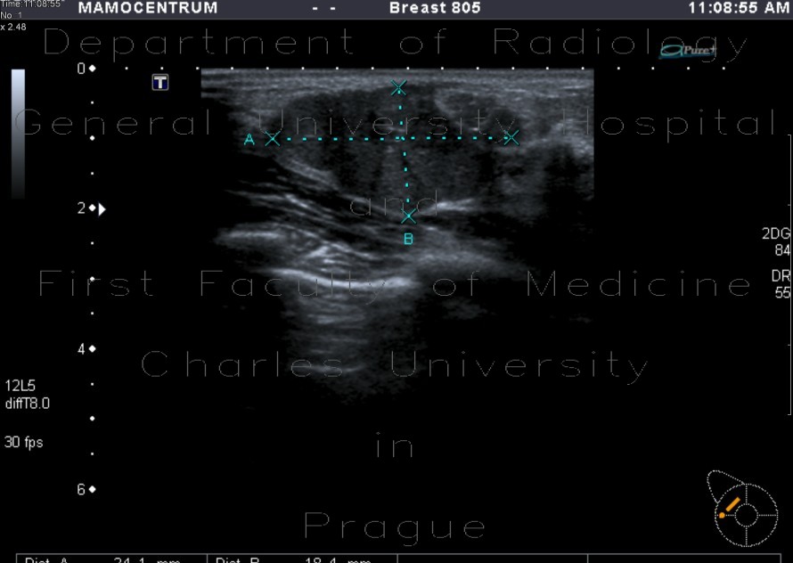 Biopsy of breast