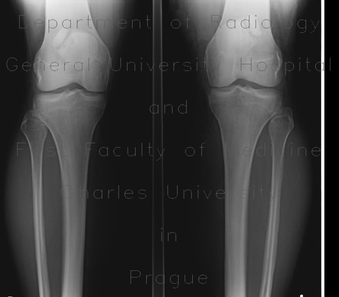 Bipartite patella