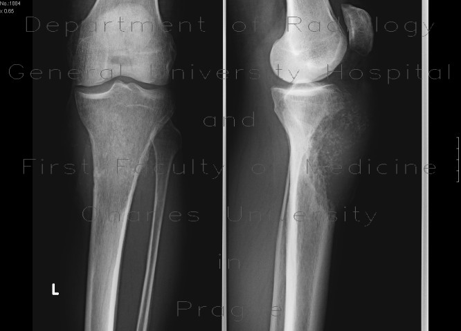Radiology image - Bladder carcinoma, bone metastasis: Abdomen, Extremity, Bone, Urinary tract: X-ray - Plain radiograph