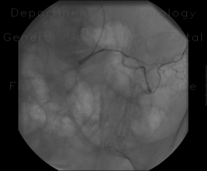 Bleeding in sigmoid colon, embolization