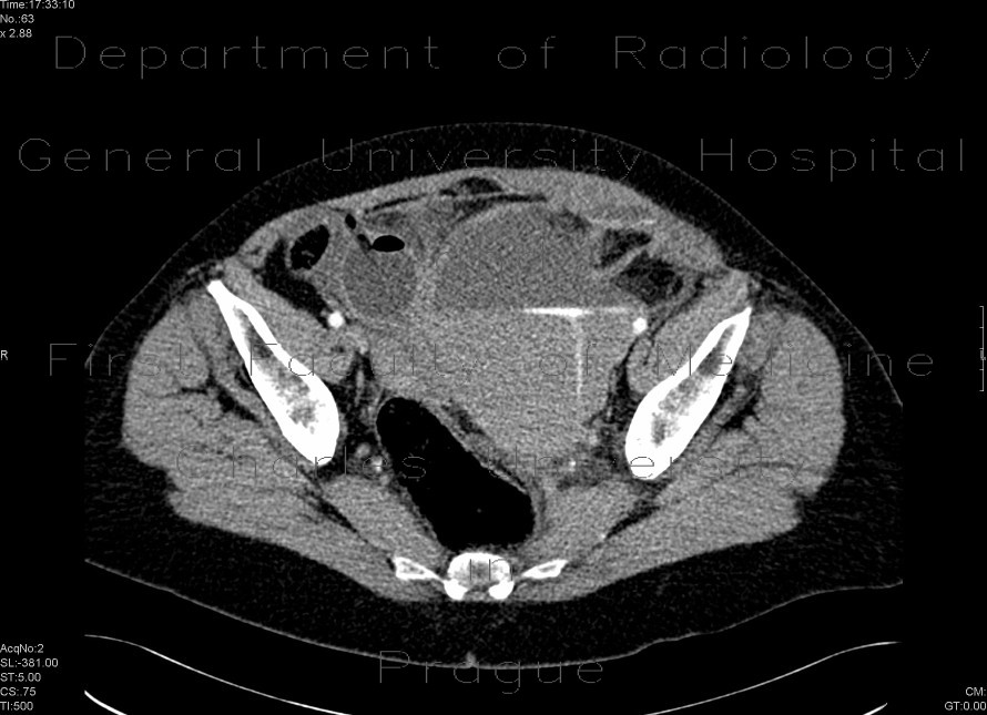 Bleeding into urinary bladder