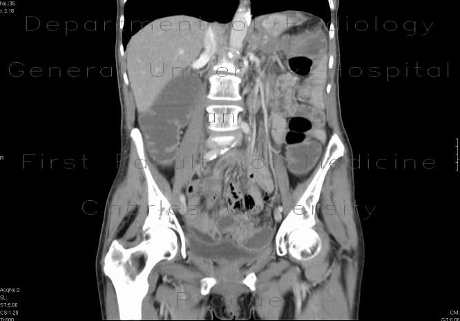 Radiology image - Blind stenosis of sigmoid colon, ileus: Abdomen, Large bowel: CT - Computed tomography