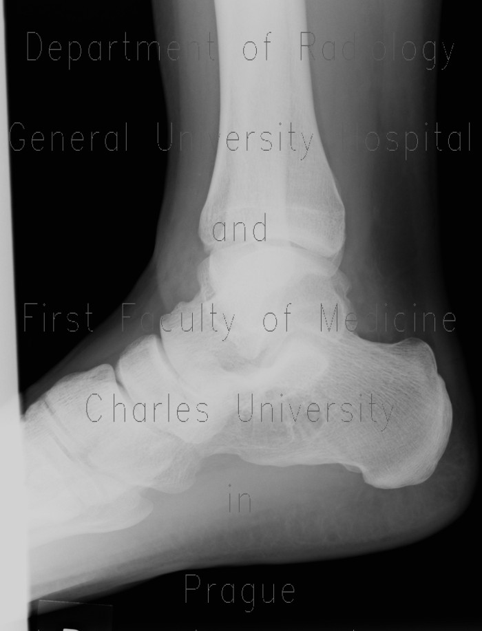 Bone cyst of calcaneus