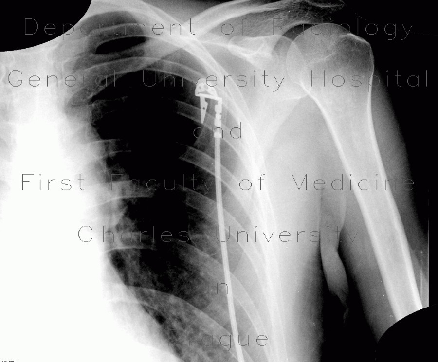 Radiology image - Bone infarct, secondary finding: Extremity, Bone: X-ray - Plain radiograph