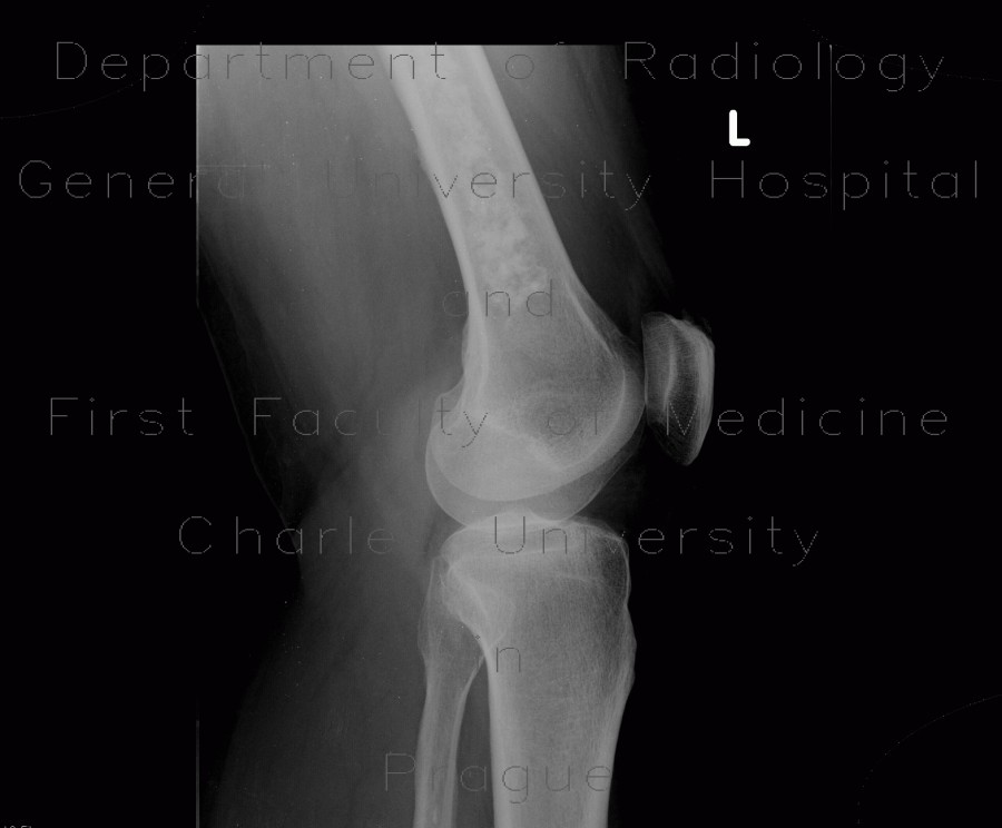 Bone infarction