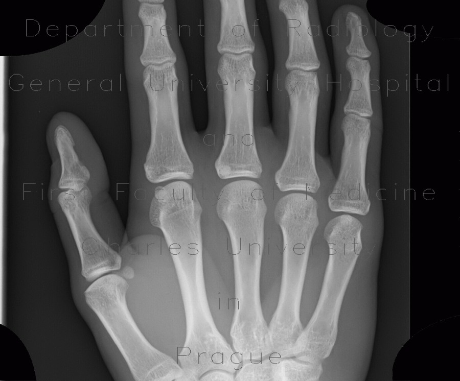 metacarpal x ray