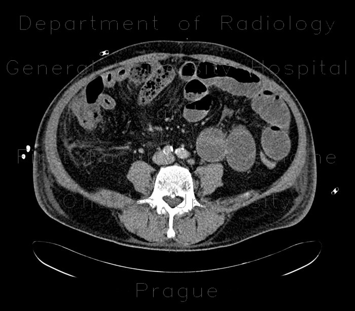 Radiology image - Bowel ischemia, vascular ileus: Abdomen, Small bowel: CT - Computed tomography
