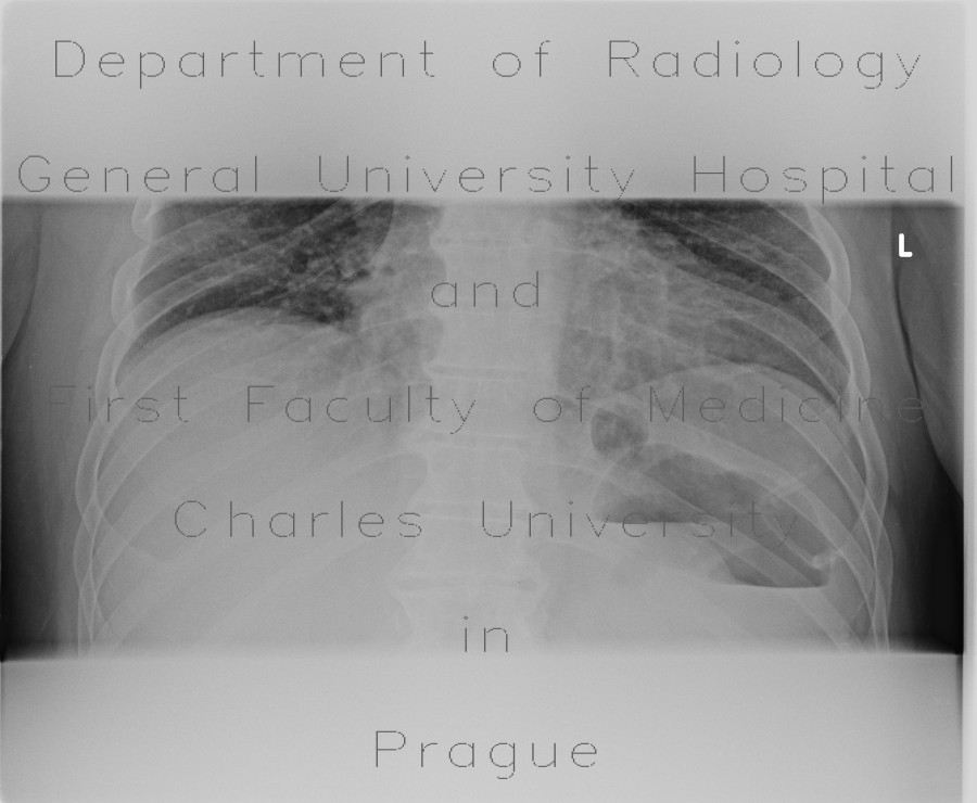 Bowel obstruction, carcinoma of sigmoid colon, SBO, ileus, colorectal cancer