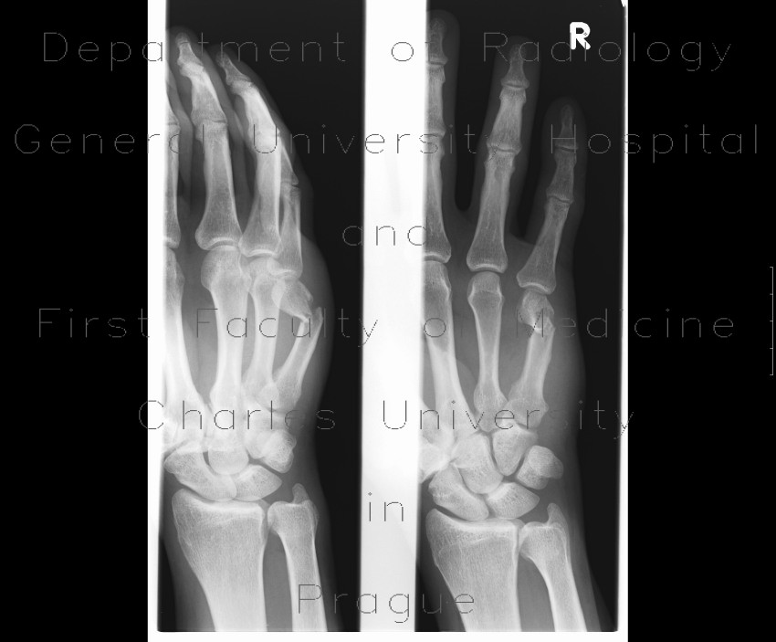 Boxer's fracture