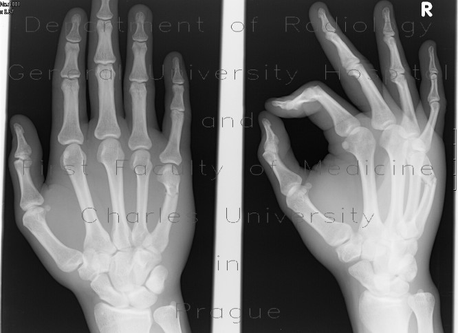 Boxer's fracture