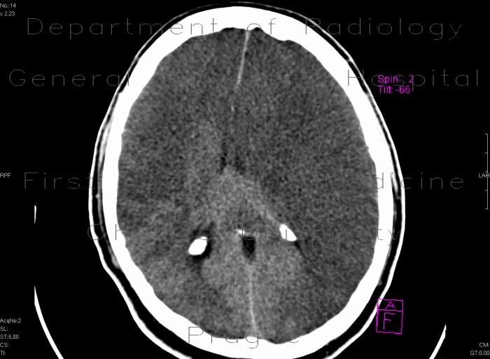 Radiology image - Brain edema, subfalcine herniation: Brain, Brain: CT - Computed tomography