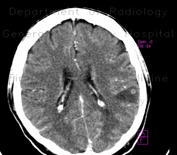 Radiology image - Brain metastasis: Brain, Brain: CT - Computed tomography