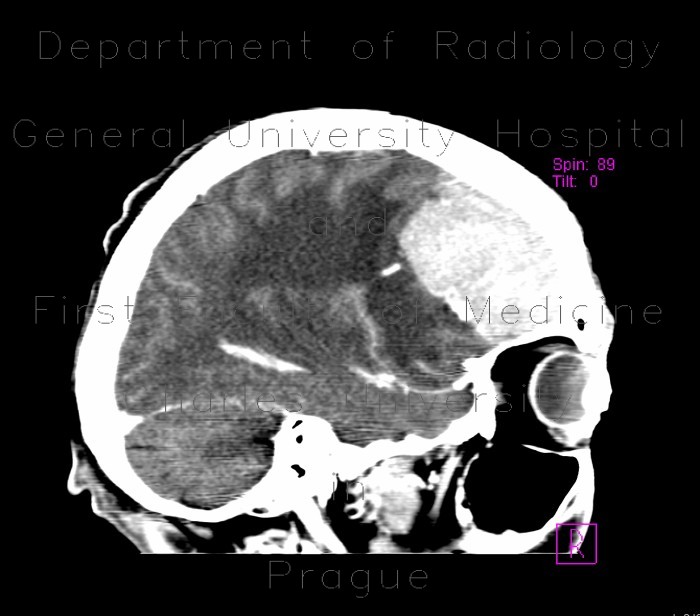 Radiology image - Brain tumour, meningioma: Brain, Brain: CT - Computed tomography