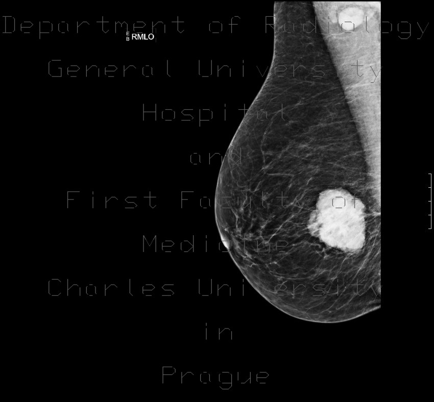 Radiology image - Breast carcinoma, big: Thorax, Breast: MMG - Mammography