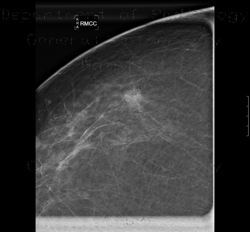 Breast carcinoma, small