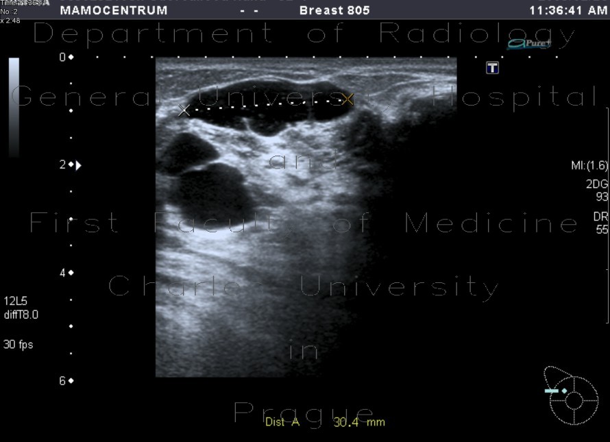 Radiology image - Breast cyst: Thorax, Breast: US - Ultrasound