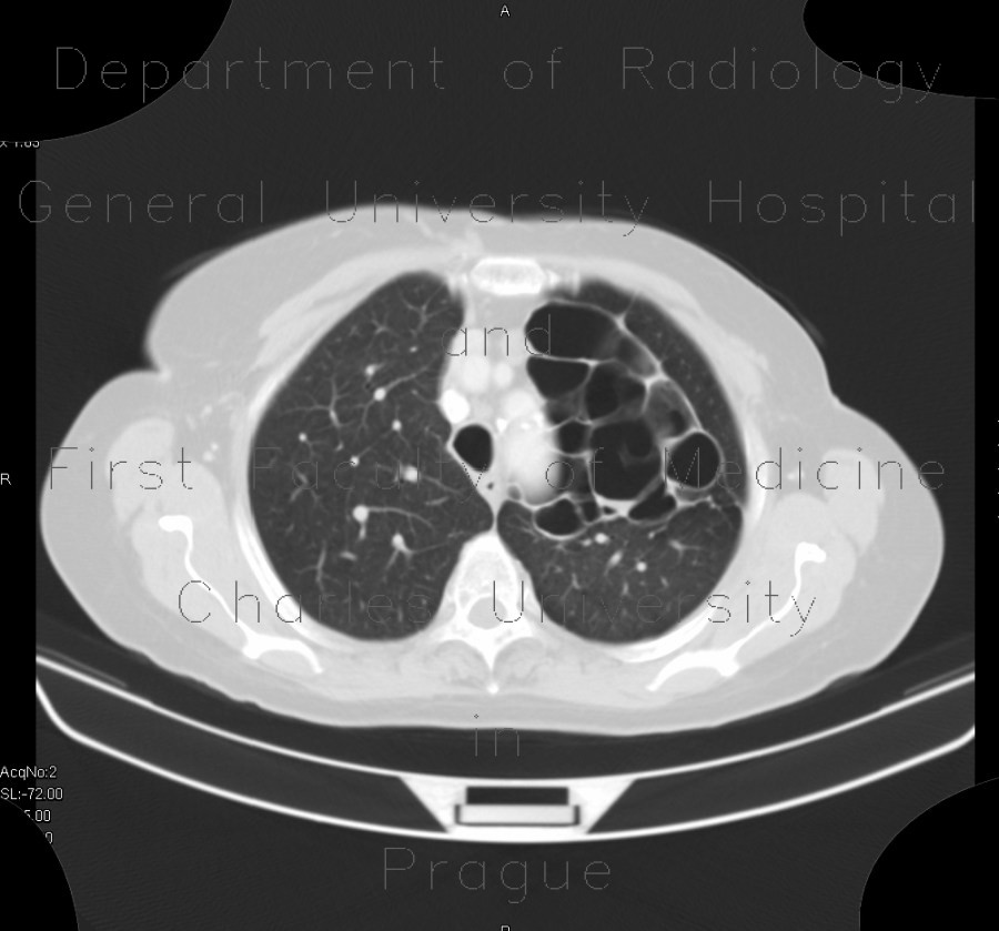 Bronchiectasia, cystic bronchiectasia