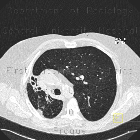 Bronchiectasias, postspecific changes