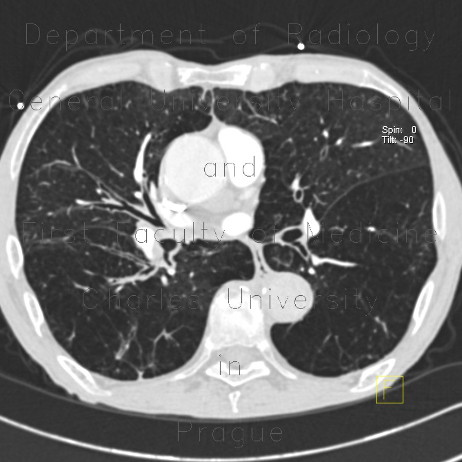 Bronchitis, panlobular emphysema