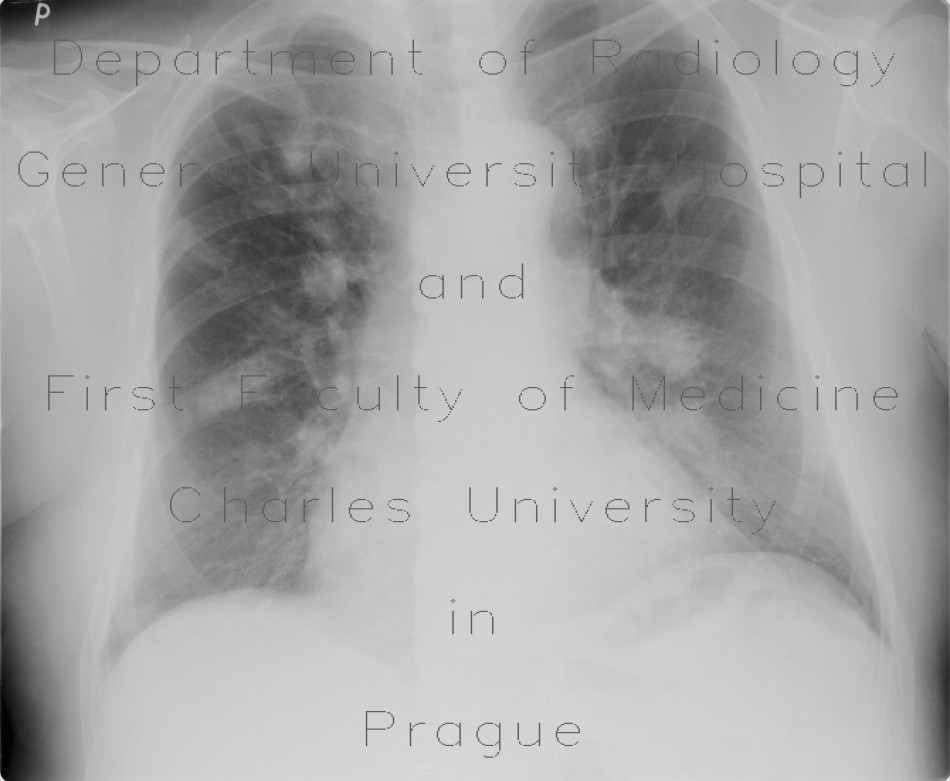 Bronchoinvasive aspergillosis, aspergillosis