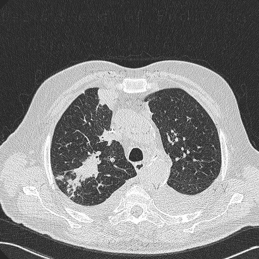 Radiology image - Bronchoinvasive aspergilosis: Thorax, Lung: CT - Computed tomography