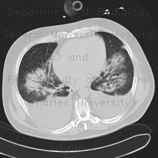 Radiology image - Bronchopneumonia, bilateral, pleural effusion: Thorax, Lung, Mediastinum and pleural cavity: CT - Computed tomography