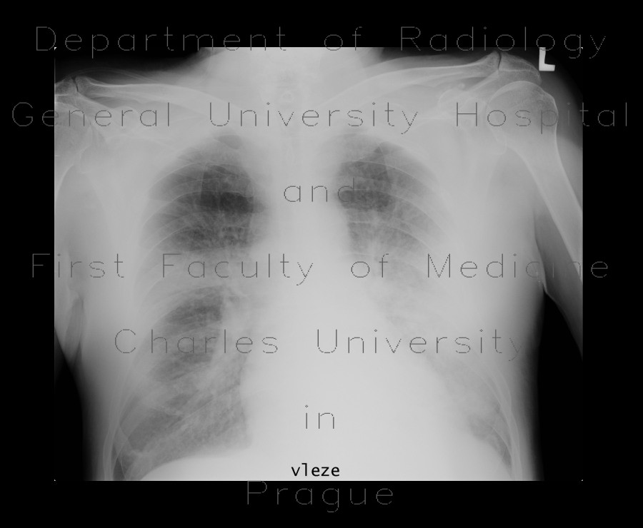 Bronchopneumonia, biopsy