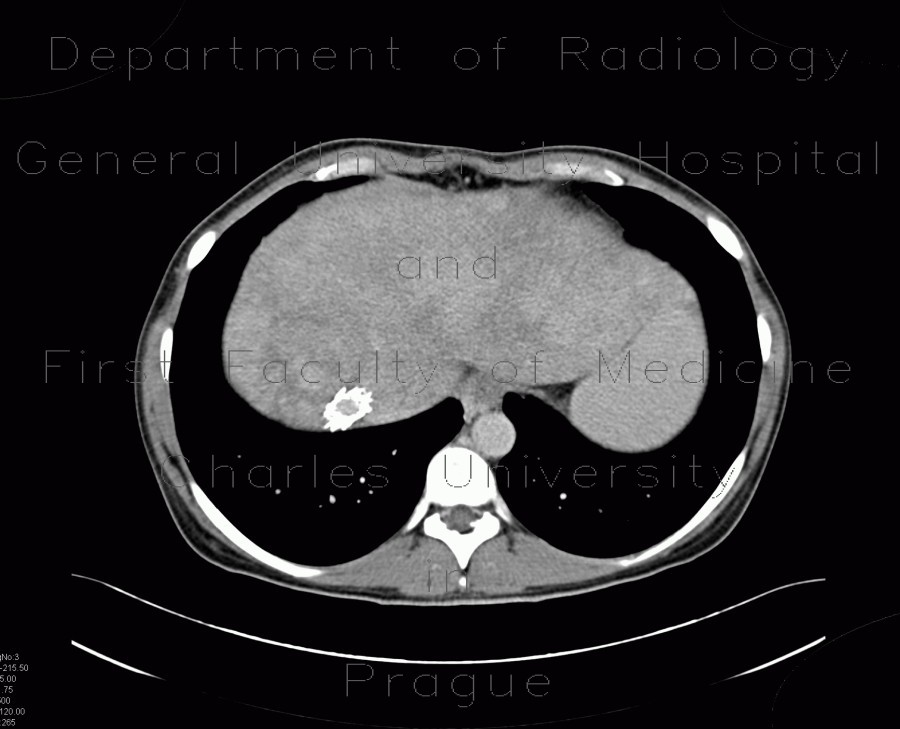 Radiology image - Budd-Chiari syndrome, thrombosis of hepatic veins, liver cirrhosis, TIPSS, splenomegally: Abdomen, Liver, Lymphatic, Vessels: CT - Computed tomography