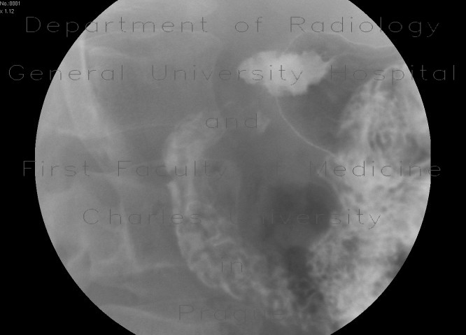 Radiology image - Bulbar ulcer: Abdomen, Small bowel: RF - Fluoroscopy