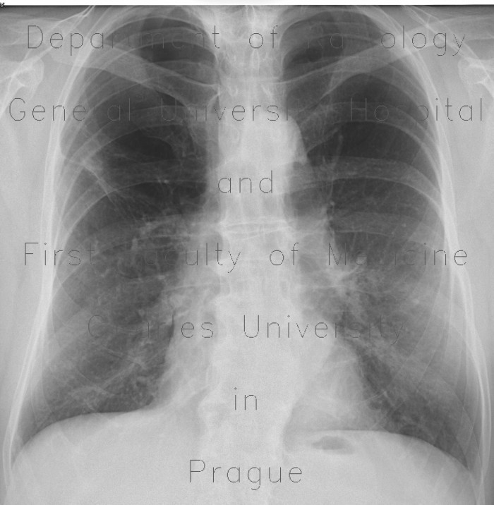 Bullous emphysema