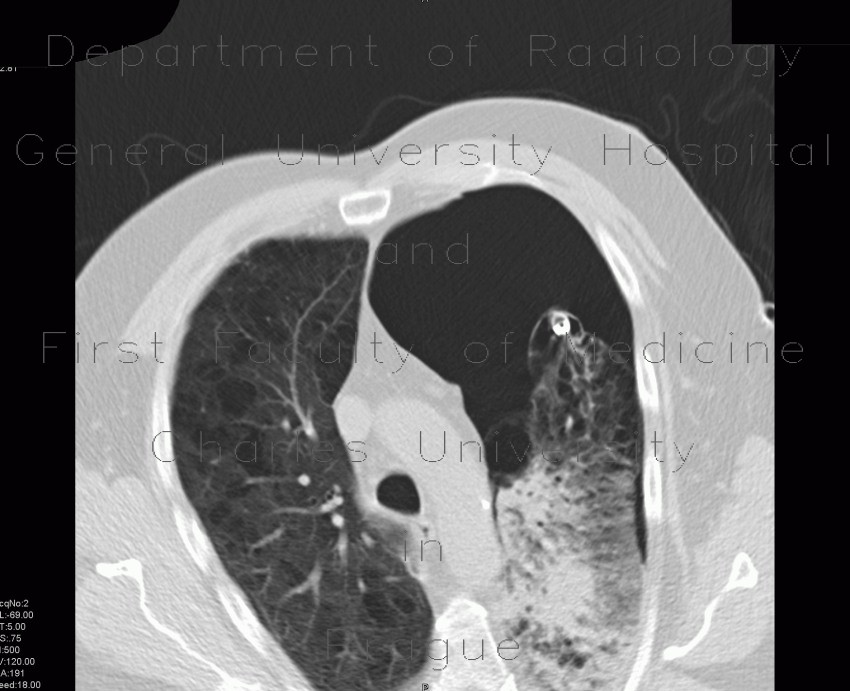 Radiology image - Bullous emphysema, pneumothorax: Thorax, Lung, Mediastinum and pleural cavity: CT - Computed tomography