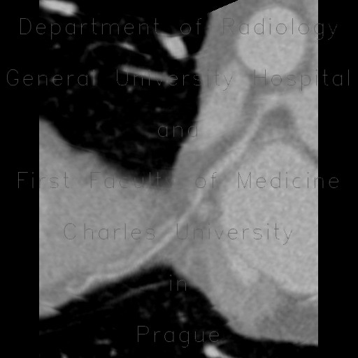 CT angiography of heart