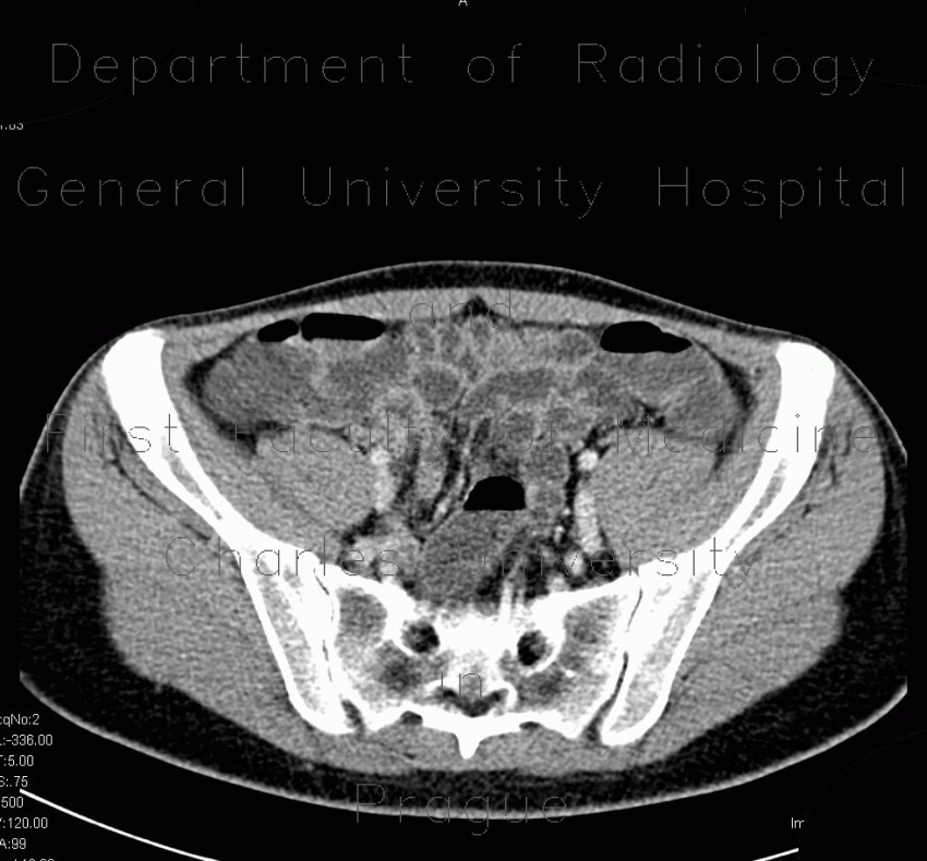 Radiology image - CT enterography, low-dose: Abdomen, Other, Small bowel: CT - Computed tomography
