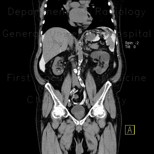 Radiology image - CT peritoneography: Abdomen, Peritoneal cavity: CT - Computed tomography