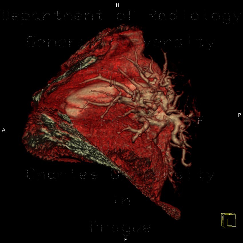 CTEPH, chronic thromboembolic pulmonary arterial hypertension, VRT