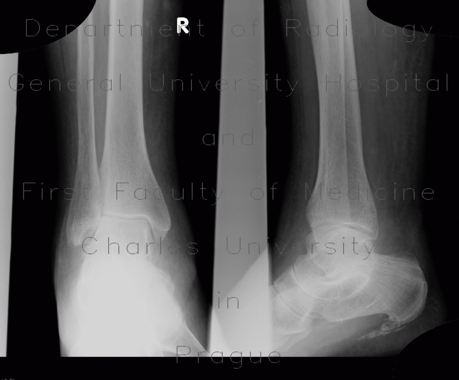 Calcar calcanei, calcifications in plantar aponeurosis, spur