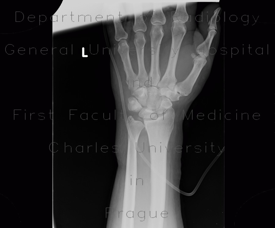 Radiology image - Calcification in TFCC, triangular fibrocartilage complex: Extremity, Soft tissue: X-ray - Plain radiograph