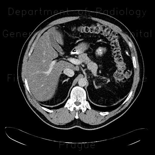 Calcification in adrenal gland