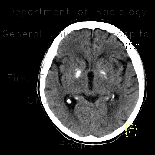 Calcification in basal ganglia