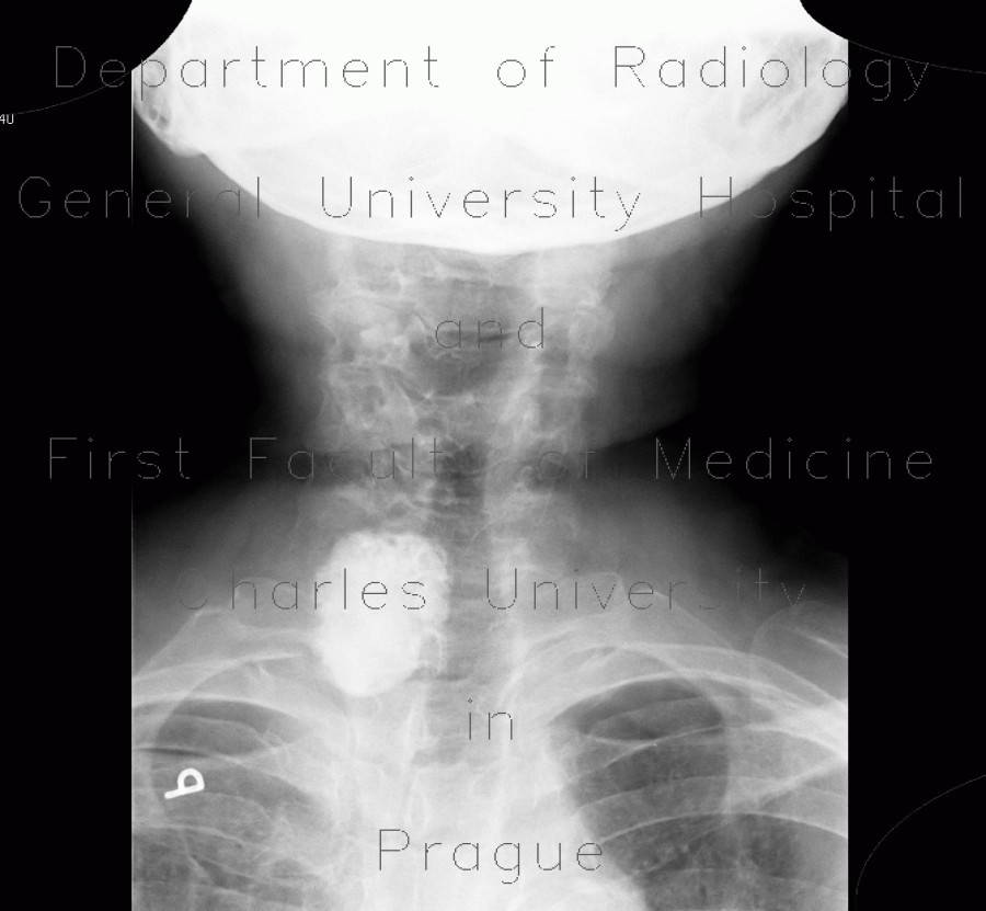 Calcification in goiter, thyroid gland