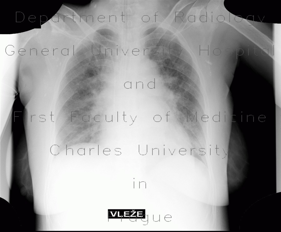 calcification of lymph nodes