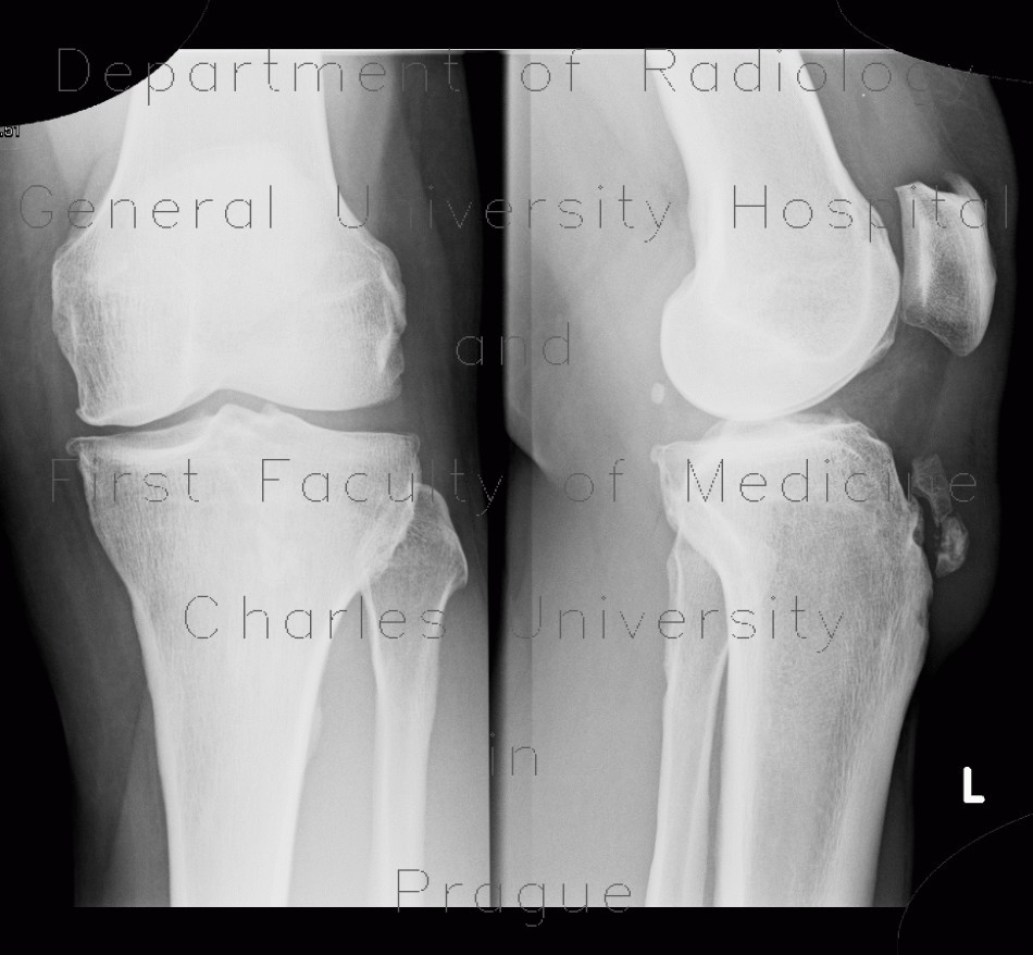 Calcification in patellar ligament, infrapatellar bursa