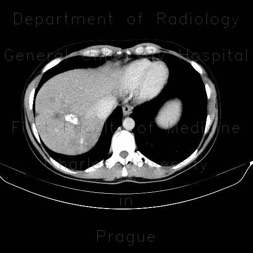 Calcification of metastases in liver from the ovarian cancer with regressive changes after treatment
