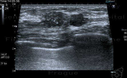 Radiology image - Calcifications in breast: Thorax, Breast: US - Ultrasound