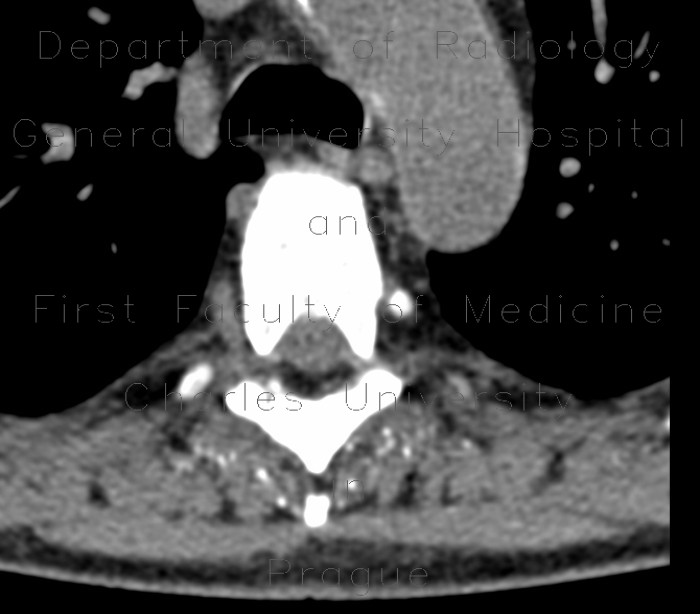 Calcifications in soft tissue in a dialysed patient