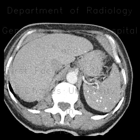 Calcifications in spleen, miliary calcifications, tuberculosis